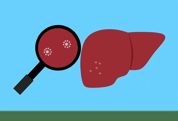 La Nash maladie : Tout savoir sur la stéatohépatite non alcoolique